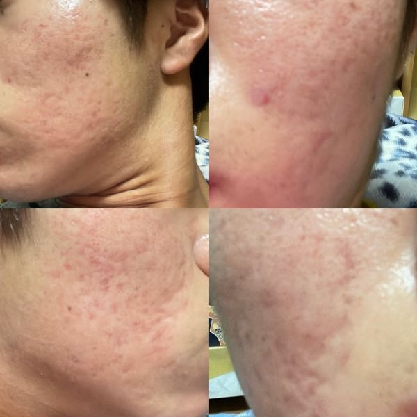 ニキビケア 解決済みの質問 Yahoo 知恵袋