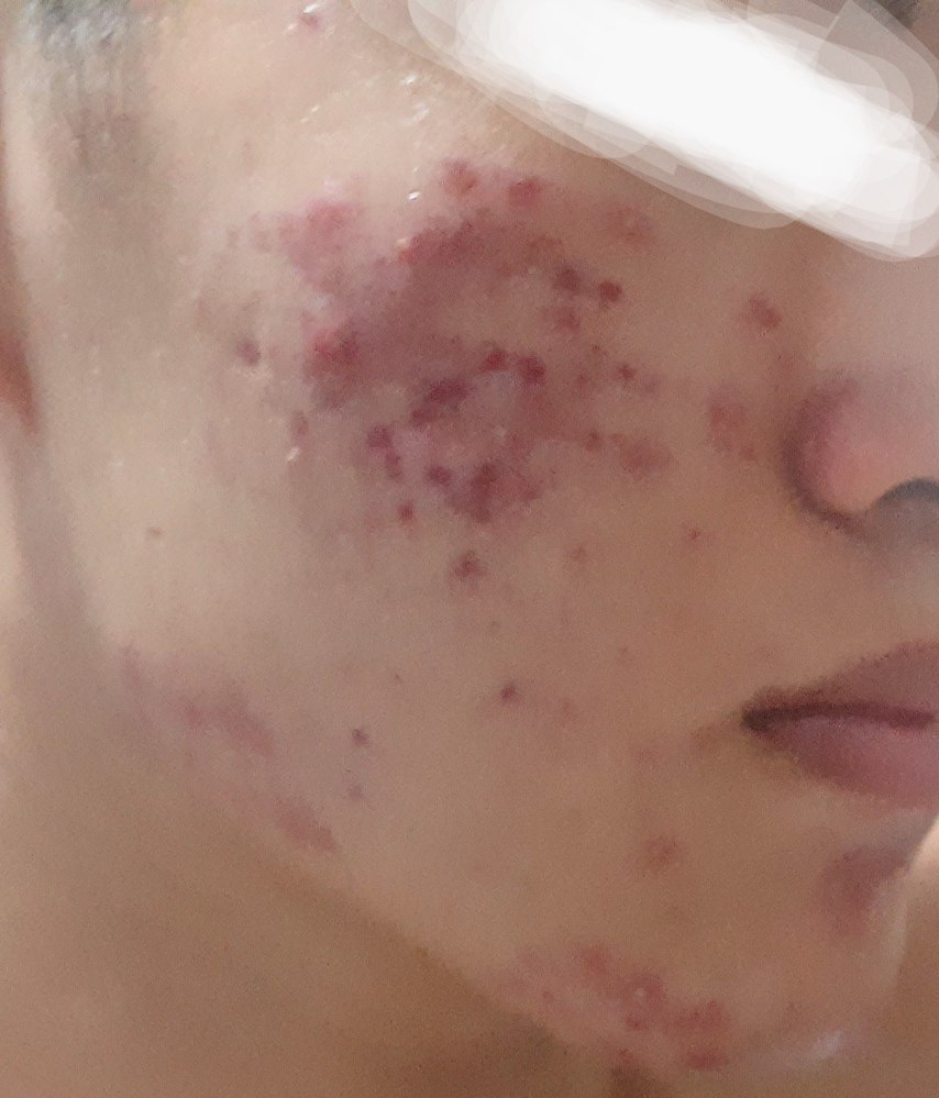 ニキビケア 解決済みの質問 Yahoo 知恵袋