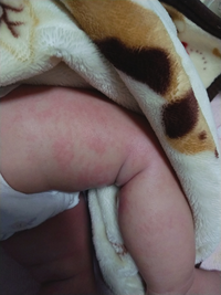 0歳7ヶ月の女の子です足に湿疹が出てます 口の周りにも赤く小さくポ Yahoo 知恵袋