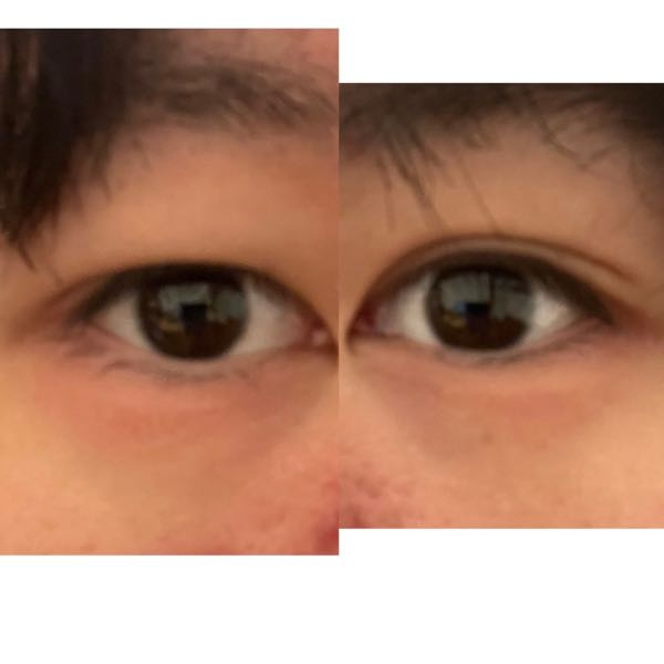 左目は割と綺麗な二重なんですが右目が一重でなぜ左右でこんなに違うんですか？ どっちも二重にすることは出来ますか