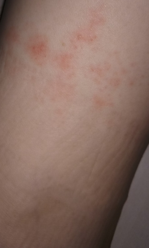 [写真あり]これってアレルギーですか？ かゆみはないです。靴下のゴムのすぐ上で内くるぶし側です。 左足にも同じようなものがあります。