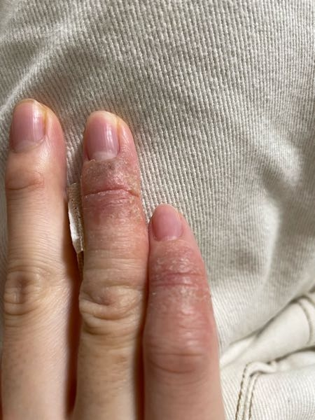半年ほど前から薬指が痒く、気になっていたものの放っておいたら小指にも痒みが飛び火していました。 皮膚の爛れが酷く、痒かったものが最近は痛いです。 少し腫れもあります。 この症状の病名及び原因はな...