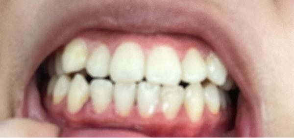 【注意】口内(歯)の写真 ずっと歯茎が下がってるように感じていたのですが、これって普通の歯茎なのでしょうか？やはり歯医者などにかかったほうがいいでしょうか。