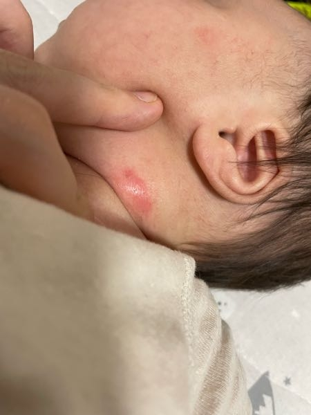 生後3ヶ月の赤ちゃんの首元の写真です。 ここ最近首元だけこの様な赤みが出て来ました。 汗疹っぽく無い気がするのですが… この炎症っぽいのは現在首元のみにしかできていません。 汗疹の一種なのでしょうか？