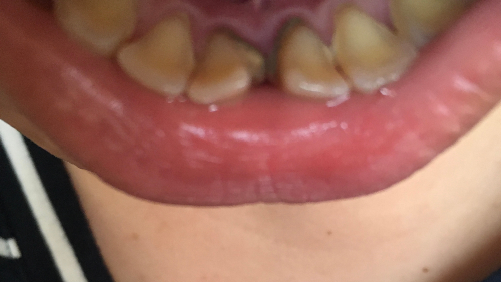 汚くてすみません。 歯石？が緑色っぽくなってしまってるのは虫歯ですか？ 治療に結構通うことになりますか？