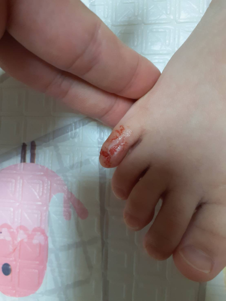 閲覧注意です。怪我の写真があります。 三才の娘が昨日怪我をしてしまいました。右足の小指です。本人は少し痛いようです。見づらくてすみません。2つ質問があります。 ①深いところの皮膚（真皮？）が少...