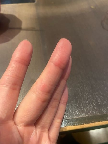 これは何かの病気でしょうか？ 1年ほど前から現れる症状です。 関節の所や、指の側面に赤い発疹？ のようなものがみられます。 触らなければ痛くないのですが、 触ったら痛いです。 （画像ではわかり...