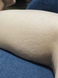 体重が一年で18キロ太りました 腕に模様ができたのですが これがセルライトで Yahoo 知恵袋