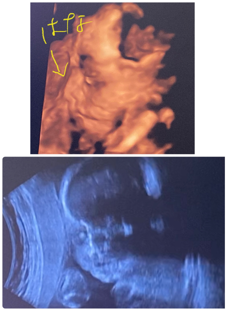 失礼を承知で質問させてください。 26週でどの結果でも産むつもりですが、このエコー写真でダウン症かどうかってわかりますか？ これは横顔の写真で判断できるのは鼻くらいかな？と思います。 医師からは...