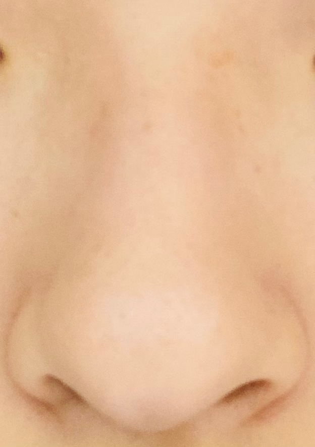 鼻の形で悩んでいます。 この鼻は何形ですか？（だんご鼻、矢印鼻など） よろしくお願いします