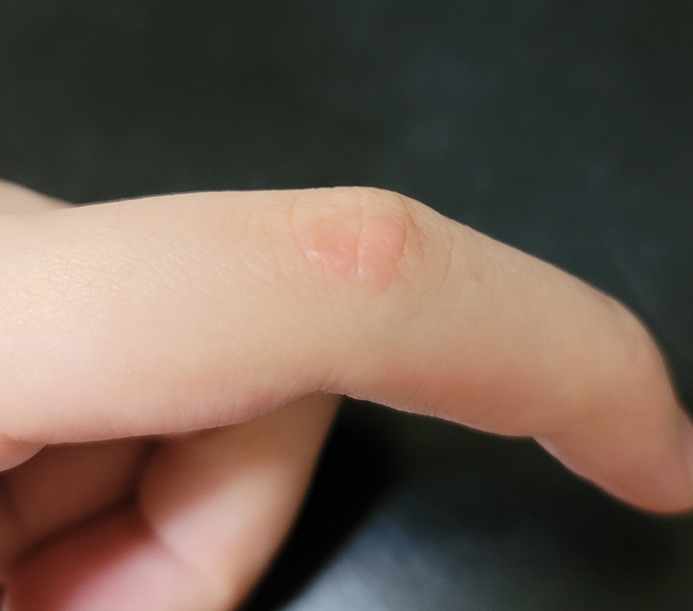 たまに左手(利き手)人差し指がボコボコになって、気になります。 痒い時と、痒くない時があります。 いつの間にか無くなります。 これはなんですか？ 皮膚専門の方回答よろしくお願いします。