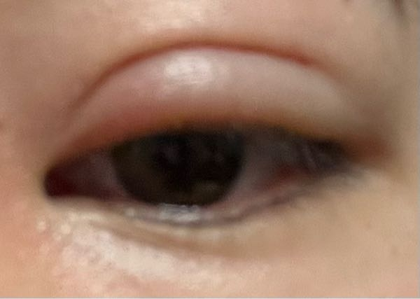 埋没して2週間たったのですが片目だけ目の腫れが収まりません。これは流石におかしいでしょうか？ちなみにもう片方の目は腫れも収まり普通の目のです。
