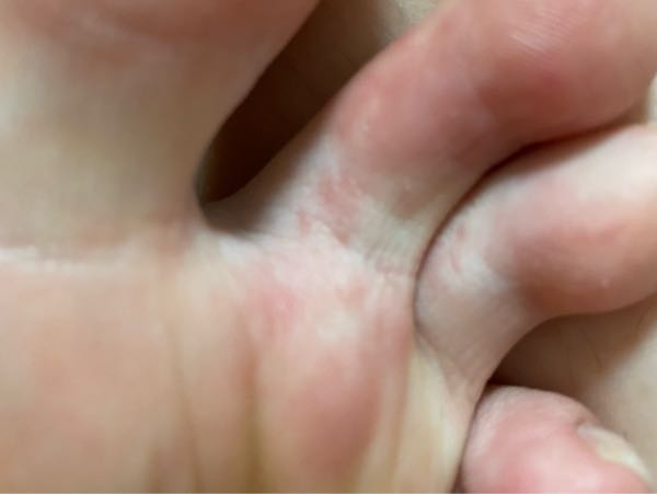 プール行ってから足の人差し指のこの横のところと中指の横のところと指の付け根付近がすごくかゆいです。 これって水虫だと思いますか？