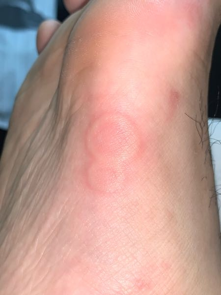 よく足に写真のような輪っか状の発疹が出るのですが、これは何でしょうか。とても痒く、皮膚科に行ったところ何かはよくわからないと言われました。