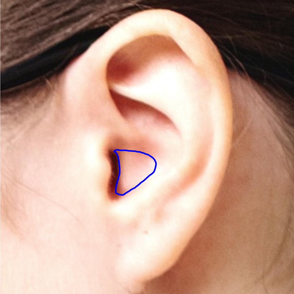 耳についての質問失礼致します 最近になってシリコン製ではないイヤホンを付け始めてから画像の青で囲んだ部分がとても痛くなんだかもう片方の耳の上記部分より柔らかくなってしまっている気がしています。こ...