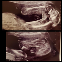 妊娠週のエコー写真です まだ性別は分かりません 同じようなエコーがあって Yahoo 知恵袋