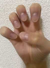 昔から爪噛みグセあって伸ばしたいしネイルしたいんですけど 爪がここまで短かっ Yahoo 知恵袋