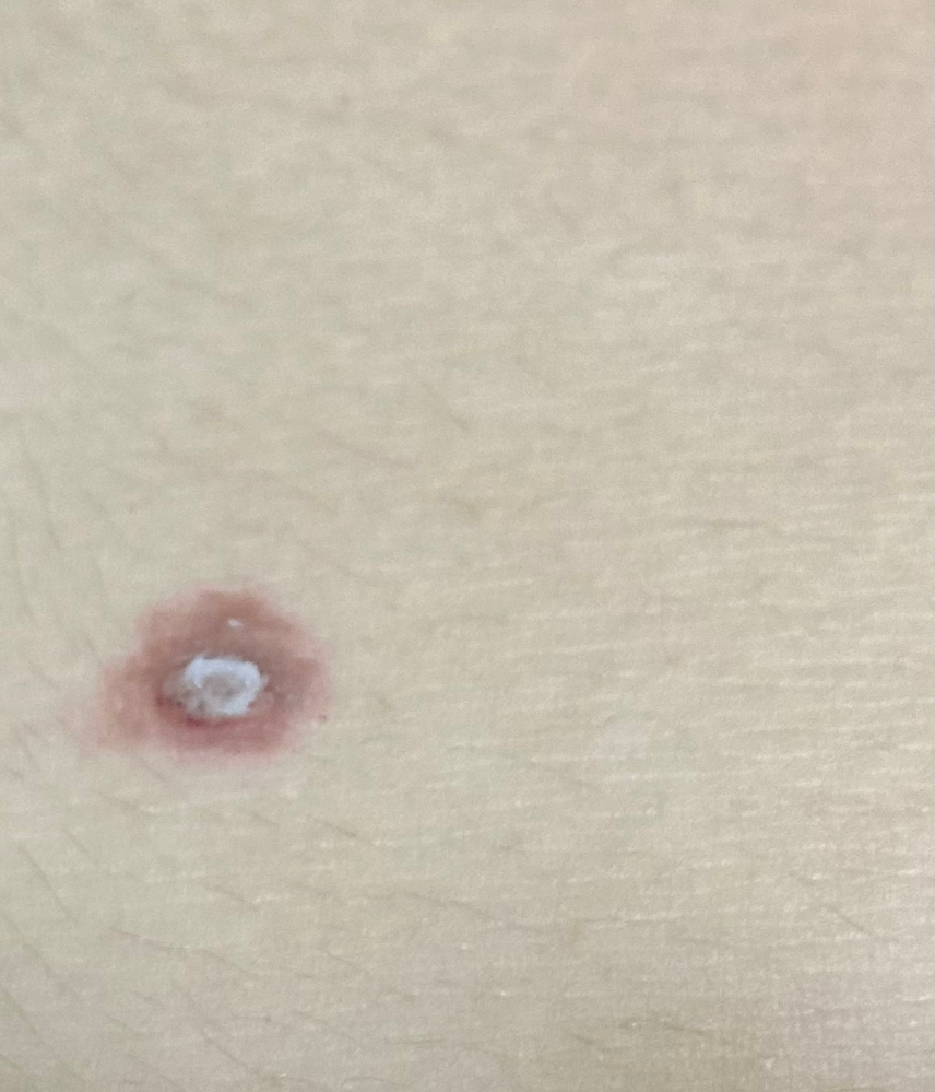 皮膚の病気 アトピー 解決済みの質問 Yahoo 知恵袋