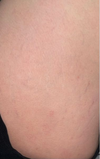 至急男性の方へ質問です 彼女が白い肉割れのある女性だったら引きますか Yahoo 知恵袋