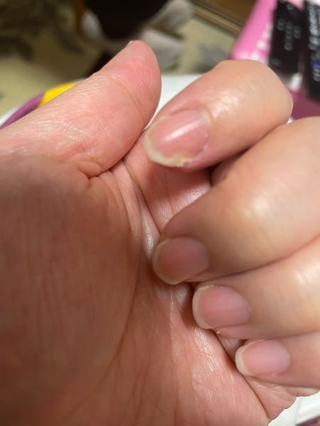 汚い爪ですみませんが 画像の人差し指なのですが 爪の白い部分の片方が（画像から見て右側指から見ると左側です） 白くなってる部分多め？で これどうやると 元に戻りますか？？ つい最近までネイルシールしてました。 ジェルネイルとかはしたことありません。 ネイルケア無知なのでわかる方お願いします。 ややスクエア型？なので ジェルネイルではなく自爪でラウンド型にしたいです。
