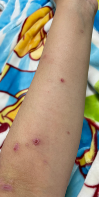 これって梅毒ですか 多分違う もっと細かいと思うよ でも 梅毒かもと思 Yahoo 知恵袋