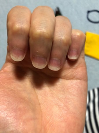 爪甲剥離症でしょうか？
自爪ケアを全くしてこなかったので、最近になって今年の冬は爪を綺麗にしようと思い、甘皮処理とネイルオイルとハンドクリームを実践してました。 すると爪の先端が白くなってしまいました。元々誰でも爪の先は白いと思うのですが、それよりやや上がスモークがかったようになってます。
裏側から見るとハイポニキウムは短いですけど一応あるんです。スモークっぽくなってるところから爪が剥げてる...