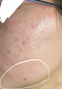 急に頬の下部分に白ニキビが大量発生しています。何か治す方法とかあり... - Yahoo!知恵袋