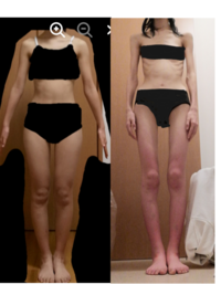 どちらの体型がいいと思いますか？ダイエットしました。（拒食症）８kg違うのに体型にあまり差がないです。。 