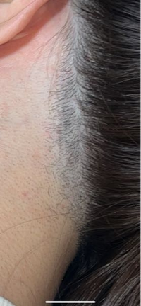 医療脱毛の効果について ※写真アリ
医療脱毛を２回終えましたが、一本も抜けるとかなく、次から次へと毛が生えてきています。
今２回目を終えて１週間です。
これから抜けていくのでしょうか。 写真はうなじです。