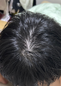 お風呂上がりのあたまなんですがこれは禿げてますか？ - 禿げてませ... - Yahoo!知恵袋