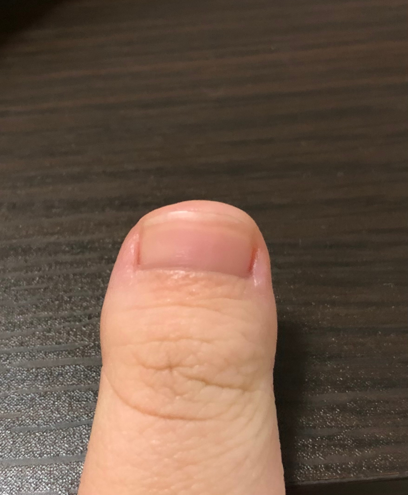 自分の親指は器用爪・マムシ爪というやつなんですが、コンプレックスで
