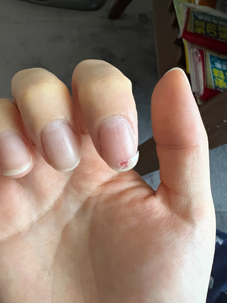 こんな感じに爪が割れてしまいました……絆創膏など貼って伸びるまで放
