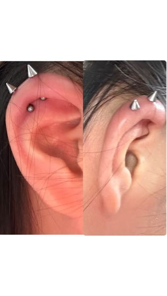 ⚠️耳の写真あります。 アンテナヘリックスを病院で開けて1週間と1日経ちます。 開けてから3日経ったくらいのとき髪をストレートアイロンやってるときに指をひっかけた？上から下にぐいっとしてしまいました。 すぐに処方されてた薬を飲んでその日はしばらく痛みがありましたが3日経つとよほどのことをしない限り大丈夫になりました。 ですが次から気をつけようと思っていたのに昨日またやってしまって、今日起きたらめっちゃ痛いし腫れていて、お薬も処方された分飲み終わってしまったのでとりあえず痛み止め（EVE）を飲んだんですが今までで1番腫れてて怖いです。 シャフトも今までは腫れてても1ミリくらいは余裕があったのがピッタリになっていて変えたいけどセカンドピアスってこともあって、全然手持ちにピアスがなくて長くても10ミリで多分このピアスも10ミリだから長いものがなくて、今できる最低限のことってなんですか？T_T 少し動かしてみたら動いたので多少は余裕がある気がします。 今は痛み止めが効いたのか常にあった痛みは無くなりました。 見苦しい耳なんですけど見ていただきたいです。 長くなってすみません。教えてくださいお願いします。