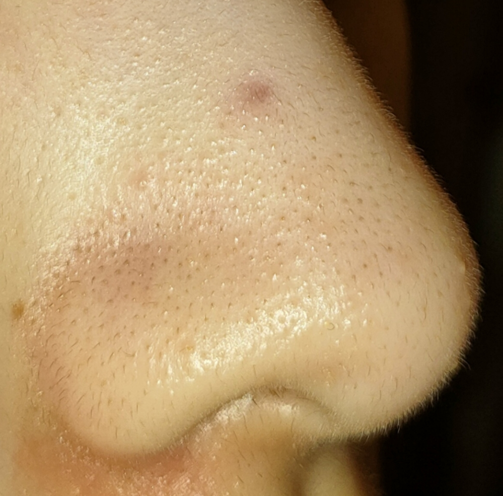 閲覧注意⚠️ 汚い鼻の黒ずみが写ります!! ↓↓↓ この毛穴のタイプはなんですか？ それと、このいちご鼻が少しでも綺麗になる スキンケアを教えてください！