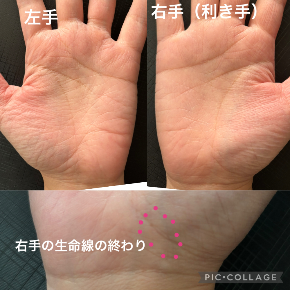 手相で生命線にある島がよくないと見て、ふと自分の手を見たらあるよう
