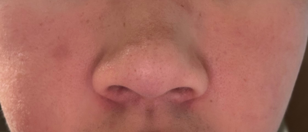 ニッキーズスキンクリア　Nikki's Skin Clear 通常用 ニッキーズスキンクリア Nikki's Skin Clear 通常使用 (シミ