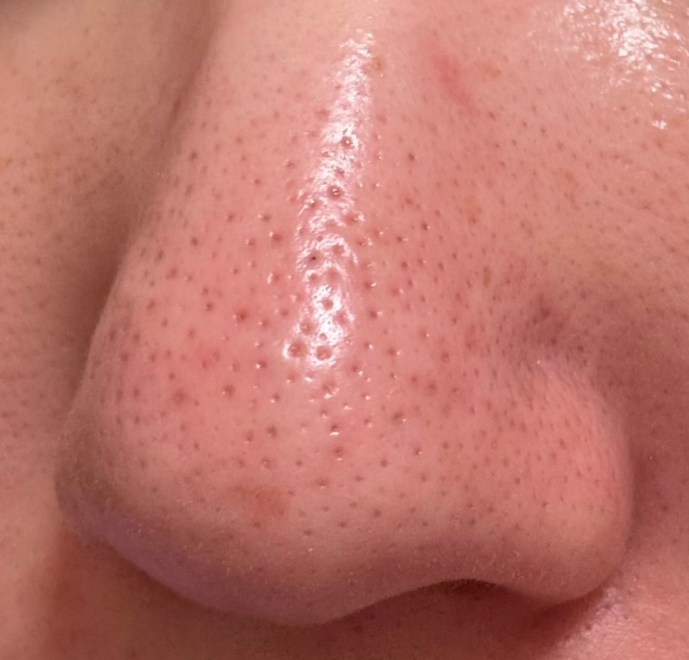 Nikki'sSkinClearニッキーズスキンクリアを実際 - Yahoo!知恵袋