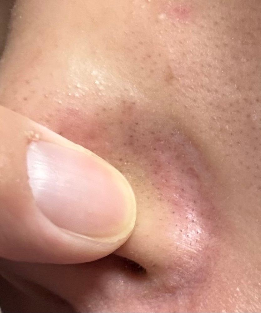 Nikki'sSkinClearニッキーズスキンクリアを実際 - Yahoo!知恵袋