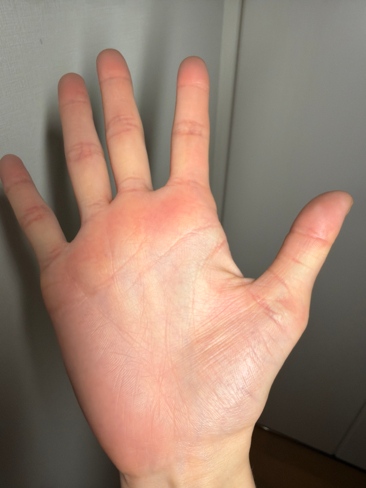 生命線に島ができ、最近体調が悪いので何かの大病にかかっているのかも