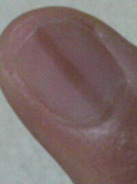 爪の黒い線現在高2ですが 小さい頃からずっと 右手の小指の爪にだけ黒い縦線が Yahoo 知恵袋