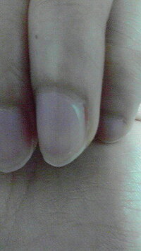 爪の傷の事で質問させて頂きます 画像の白い部分 爪が伸びても永久にその部分だ Yahoo 知恵袋