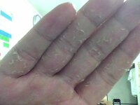 手の皮がむけます かゆくないですが先日蕁麻疹が治ったばかりですやはり蕁麻 Yahoo 知恵袋