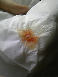 風邪 血痰について 画像有 閲覧有難う御座います 数日前に風 Yahoo 知恵袋