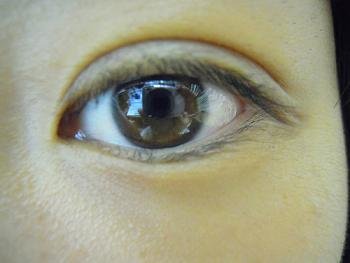 ３日前に埋没法の手術を受けました ３日前に埋没法 瞼板法 で Yahoo 知恵袋