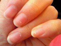 爪に白い塊があります これはなんなんでしょうか 検索してみたら水虫とかなんと Yahoo 知恵袋