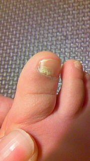 ２歳の娘の足の爪が一部白くなっています 爪水虫でしょうか また 病院に連れて Yahoo 知恵袋
