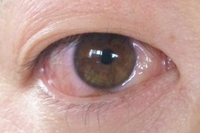 これは アレルギー性結膜炎にともなう結膜浮腫 ですか お昼頃目 Yahoo 知恵袋