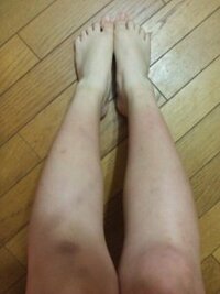 自分の脚について悩んでます。 高1女子です。今はバドミントン部です。
中学ではテニス部に入ってました。
ちなみに身長は151cmくらいですw
下の方が白いのは日焼けですww(笑 かっこ悪い…；；((

そのせいか、自分の脚に筋肉と脂肪?がついて、
蚊に刺された跡とか、すりむいた傷(小6の頃の奴なんですが、治癒めっちゃ遅い)で汚く見えます。
もともとデブな方なので…。今の体脂肪率...