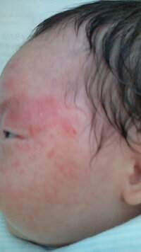 乳児湿疹について教えてください 現在1カ月の男の子です 湿疹がひどく小児科に Yahoo 知恵袋