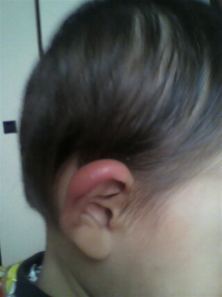 腫れる 耳たぶ